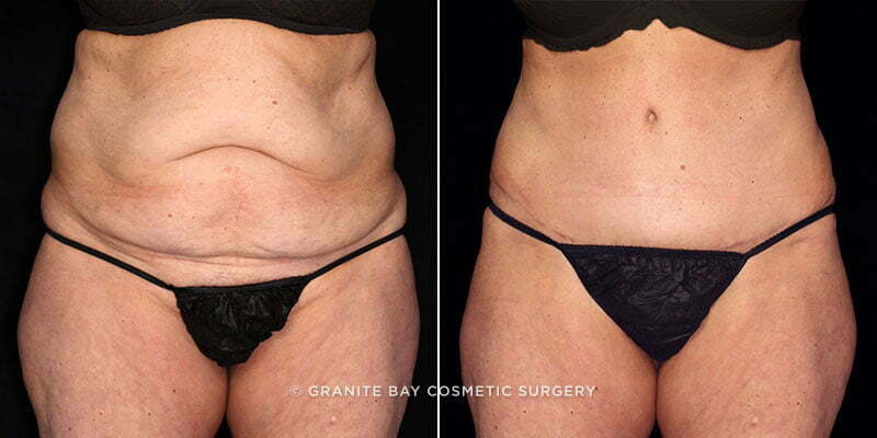 Case # 83 after photo