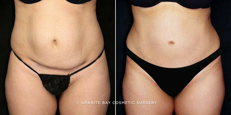 Case # 85 after photo