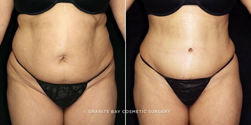 Case # 86 after photo