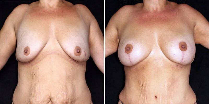 Case # 38 after photo