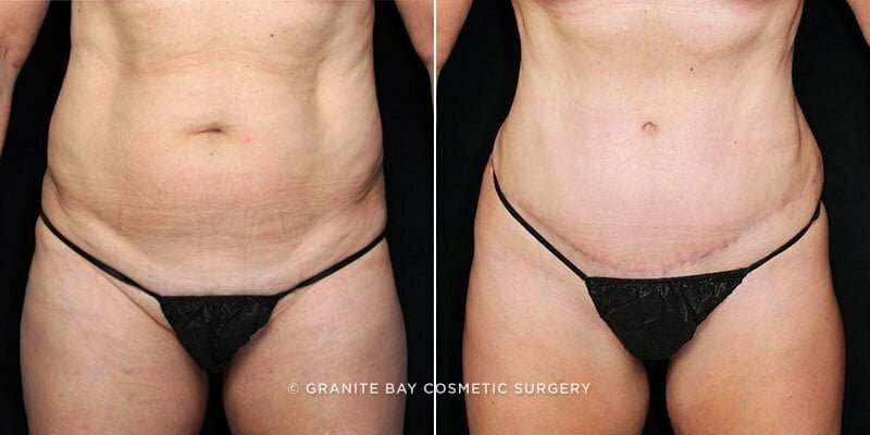 Case # 90 after photo