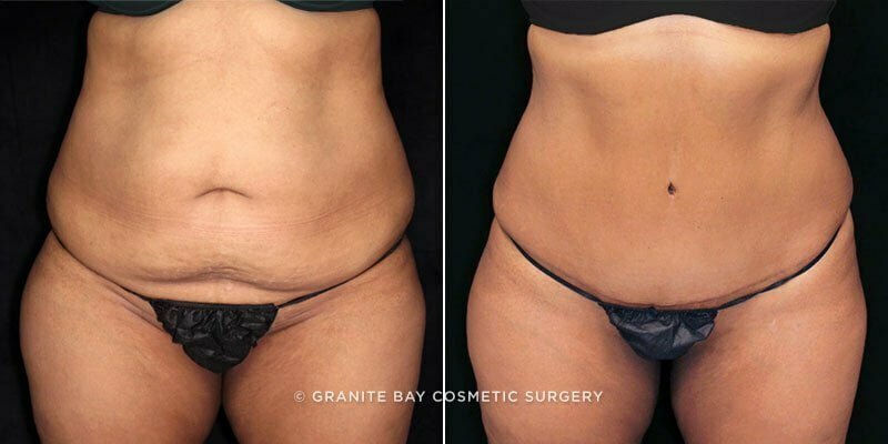 Case # 91 after photo