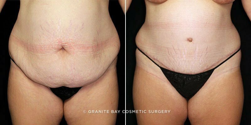 Case # 92 after photo