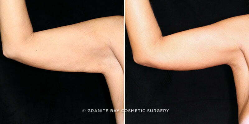 Case # 13 after photo