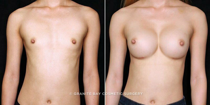 Case # 95 after photo