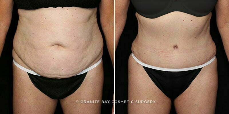 Case # 93 after photo