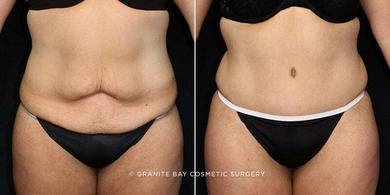 Case # 94 after photo