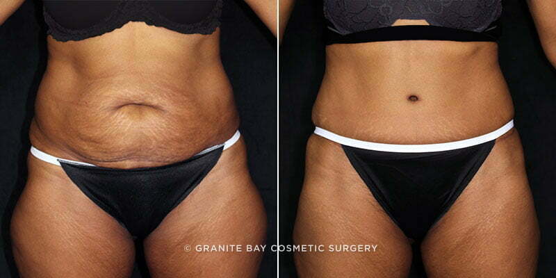 Case # 95 after photo