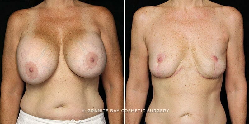 Case # 62 after photo