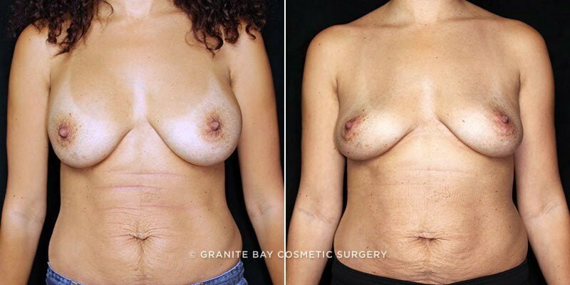 Case # 39 after photo