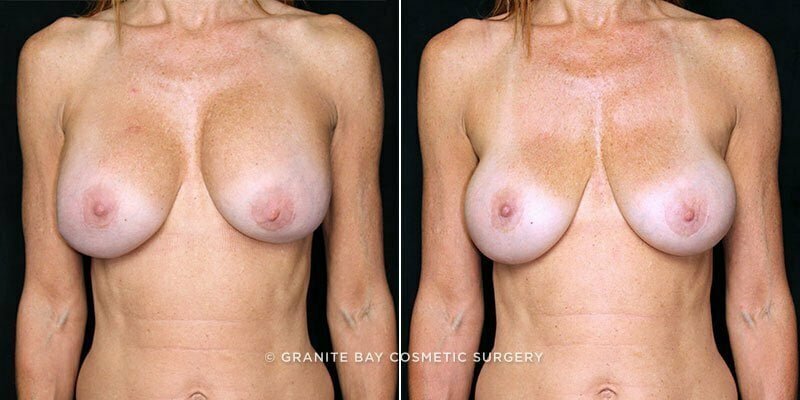 Case # 68 after photo