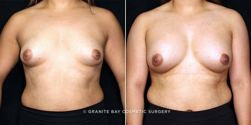 Case # 100 after photo