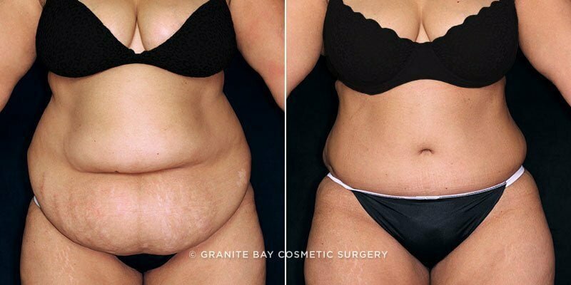 Case # 100 after photo