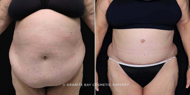 Case # 101 after photo