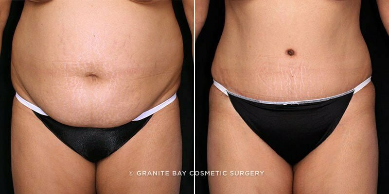 Case # 104 after photo