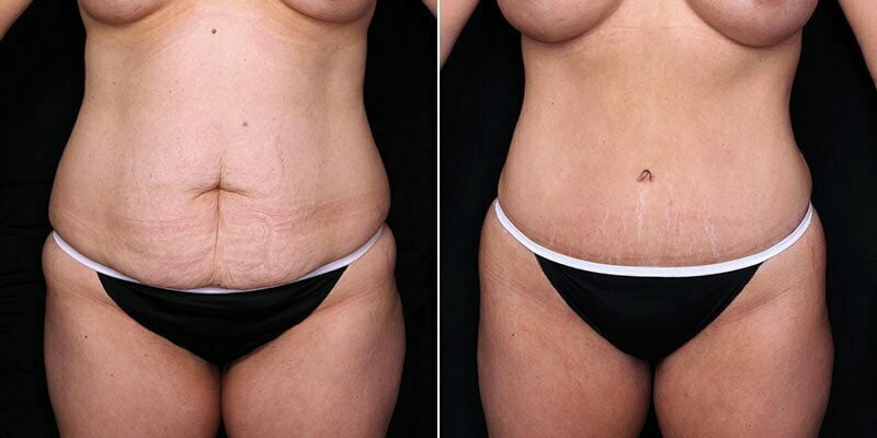 Case # 105 after photo