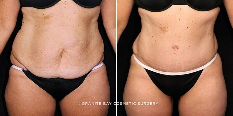 Case # 106 after photo