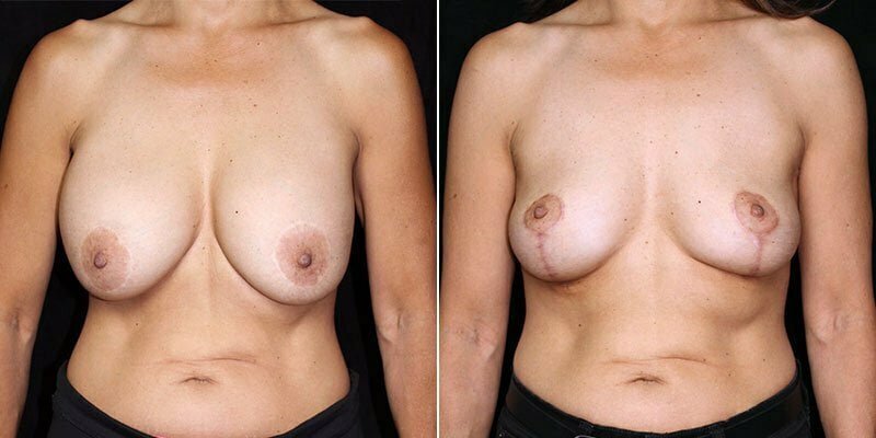 Case # 43 after photo