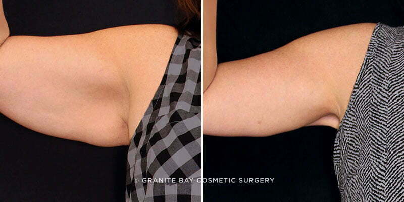 Case # 14 after photo