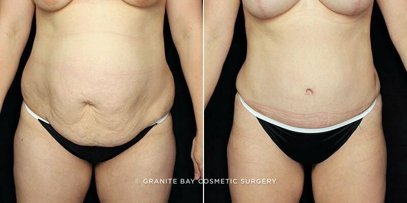 Case # 109 after photo