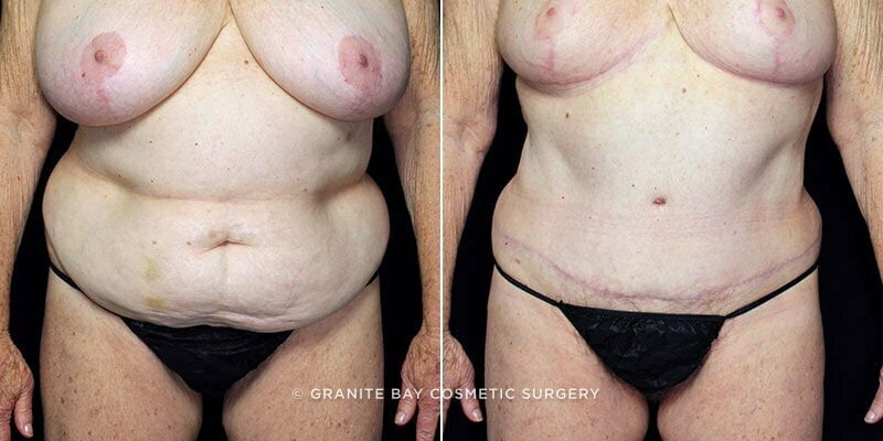 Case # 110 after photo