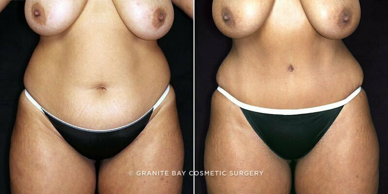 Case # 111 after photo