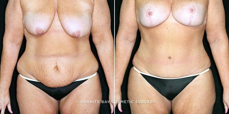 Case # 112 after photo