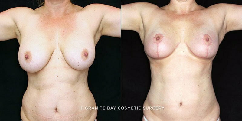 Case # 39 after photo