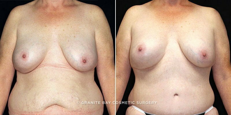 Case # 74 after photo