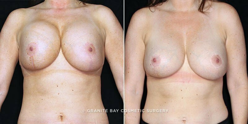 Case # 75 after photo