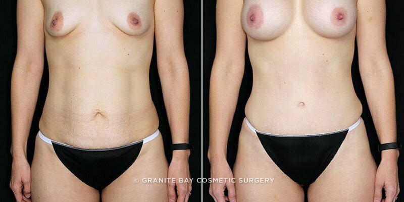 Case # 115 after photo