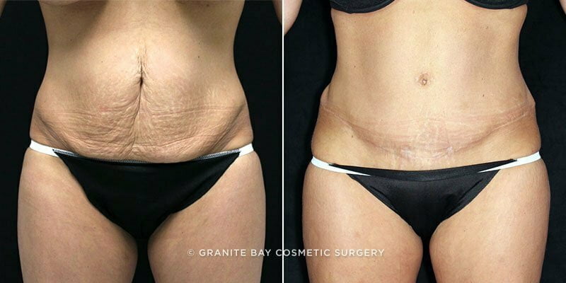 Case # 116 after photo