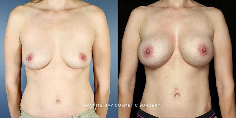 Case # 115 after photo