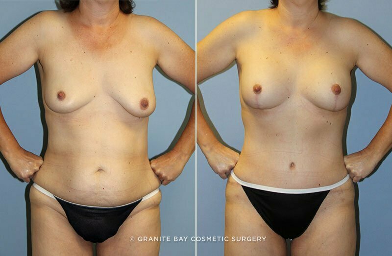 Case # 62 after photo