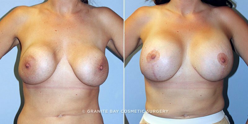 Case # 82 after photo