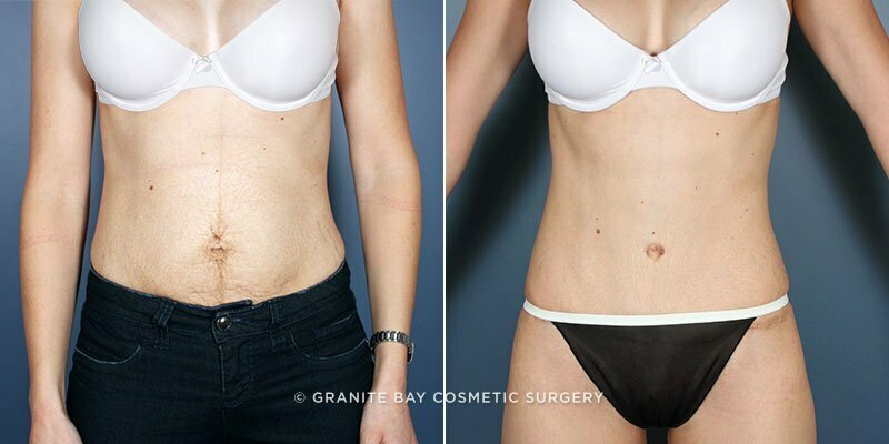 Case # 122 after photo