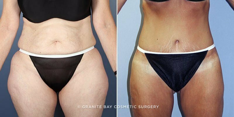 Case # 123 after photo