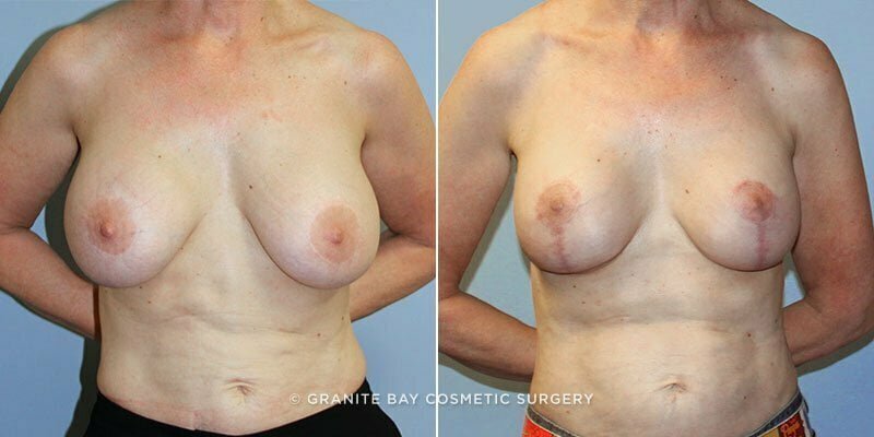 Case # 26 after photo