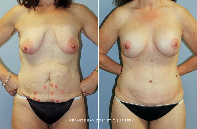 Case # 64 after photo