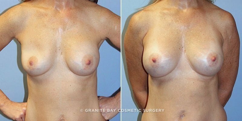 Case # 84 after photo