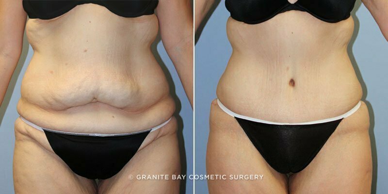 Case # 127 after photo