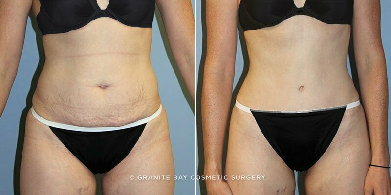 Case # 128 after photo