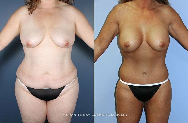 Case # 14 after photo