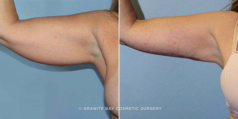 Case # 17 after photo