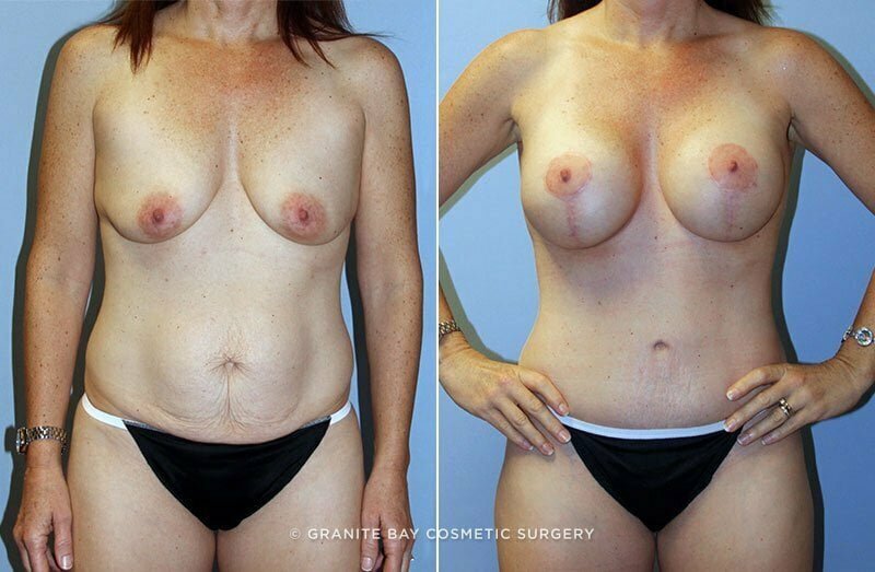 Case # 68 after photo