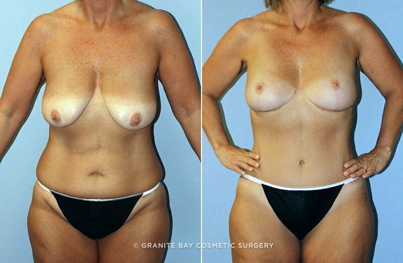 Case # 69 after photo