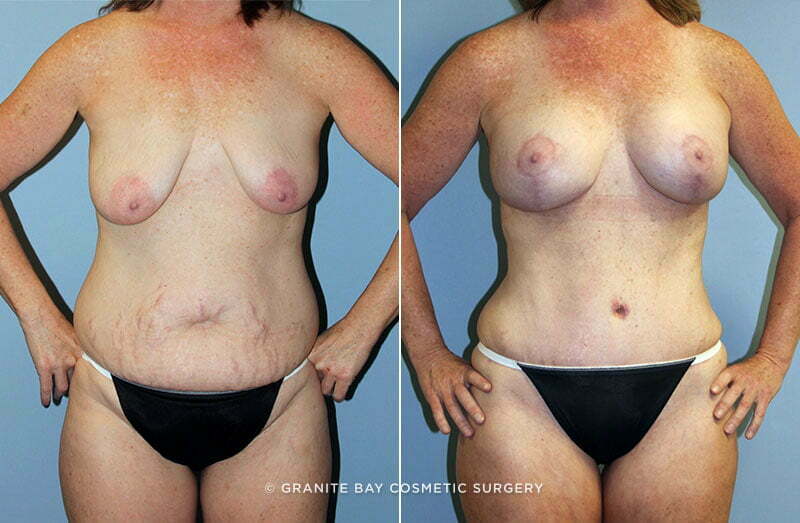 Case # 72 after photo