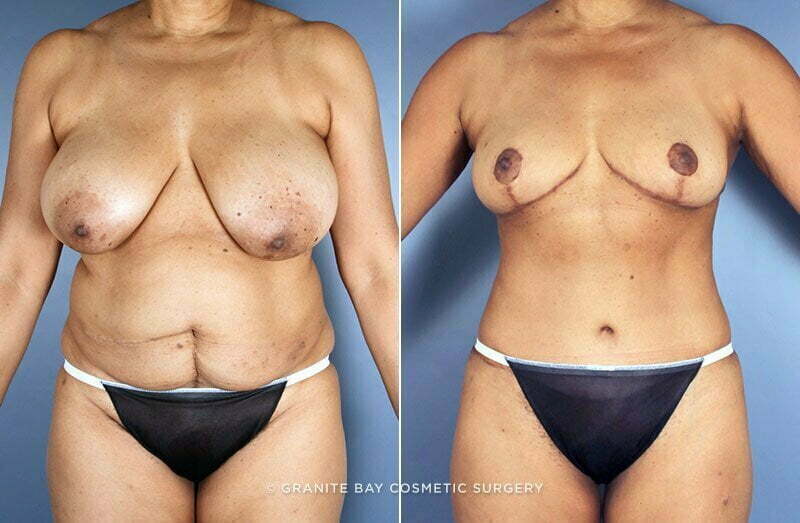 Case # 74 after photo