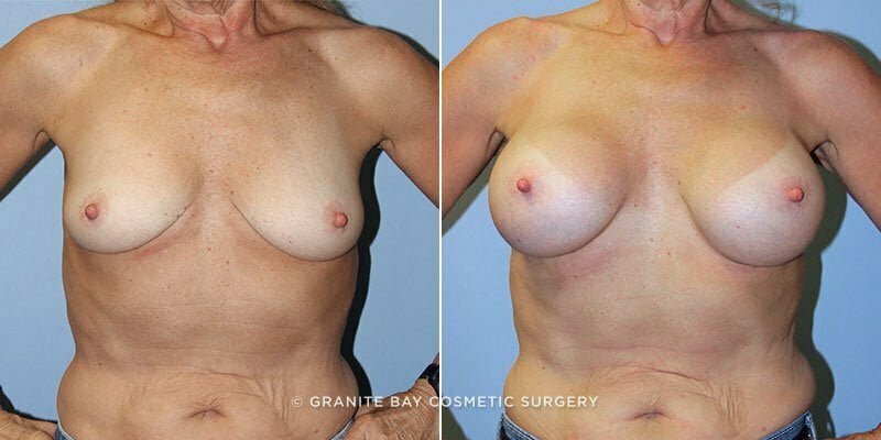 Case # 140 after photo