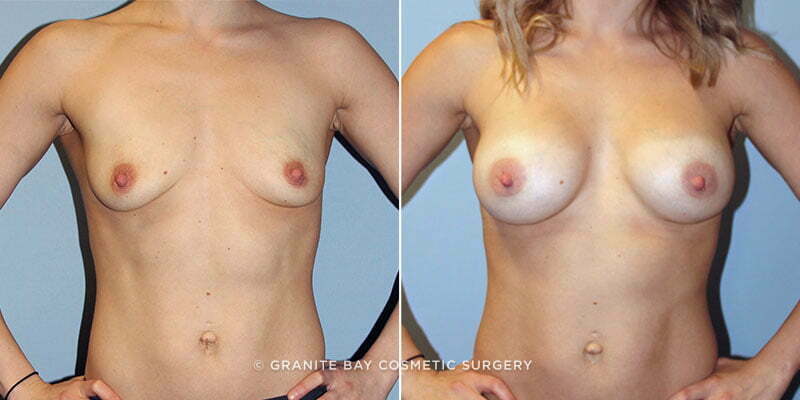 Case # 144 after photo